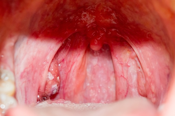 Tonsillitis,Is,Inflammation,Of,The,Tonsils,,Two,Oval-shaped,Pads,Of