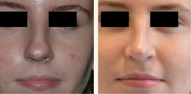 Primary Rhinoplasty Female