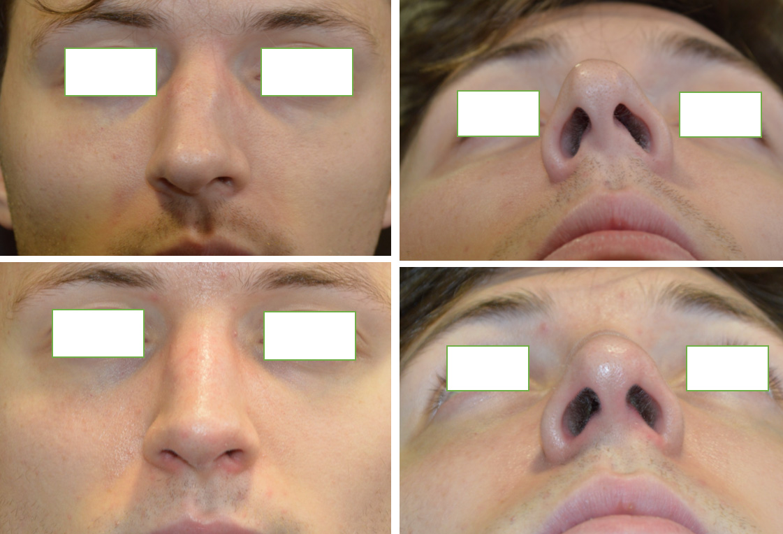 Primary Rhinoplasty Male